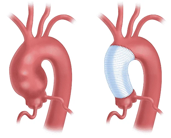 Chirurgie de l'aorte