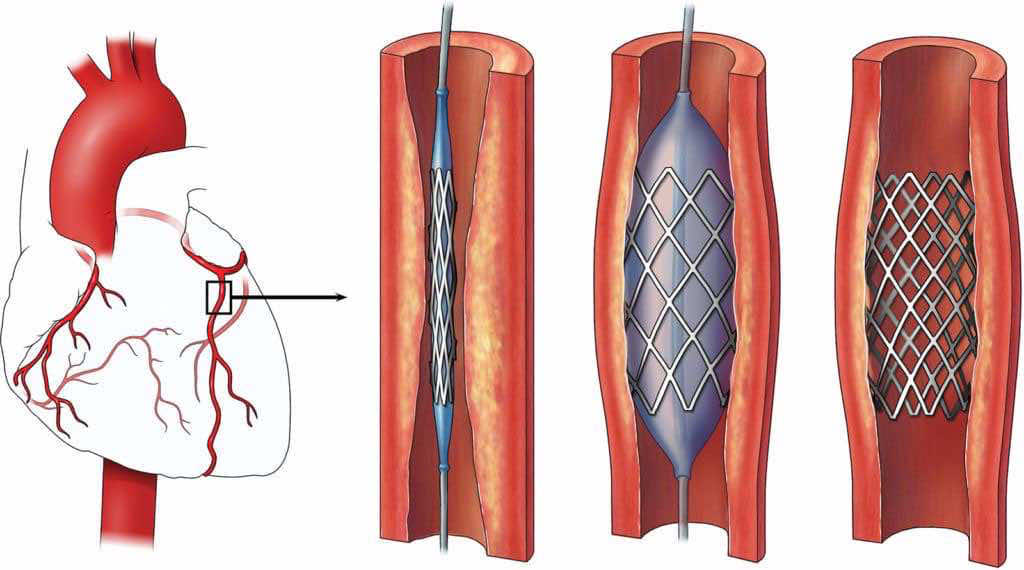 Cardiologie interventionnelle