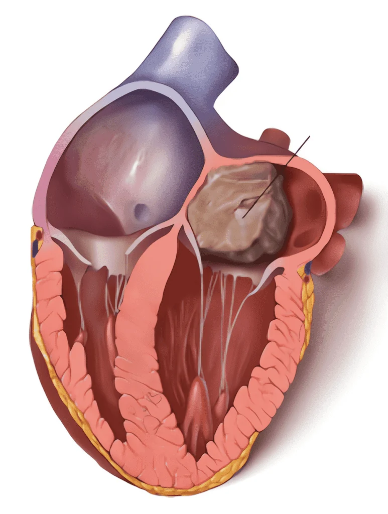 Chirurgie tumorale du cœur