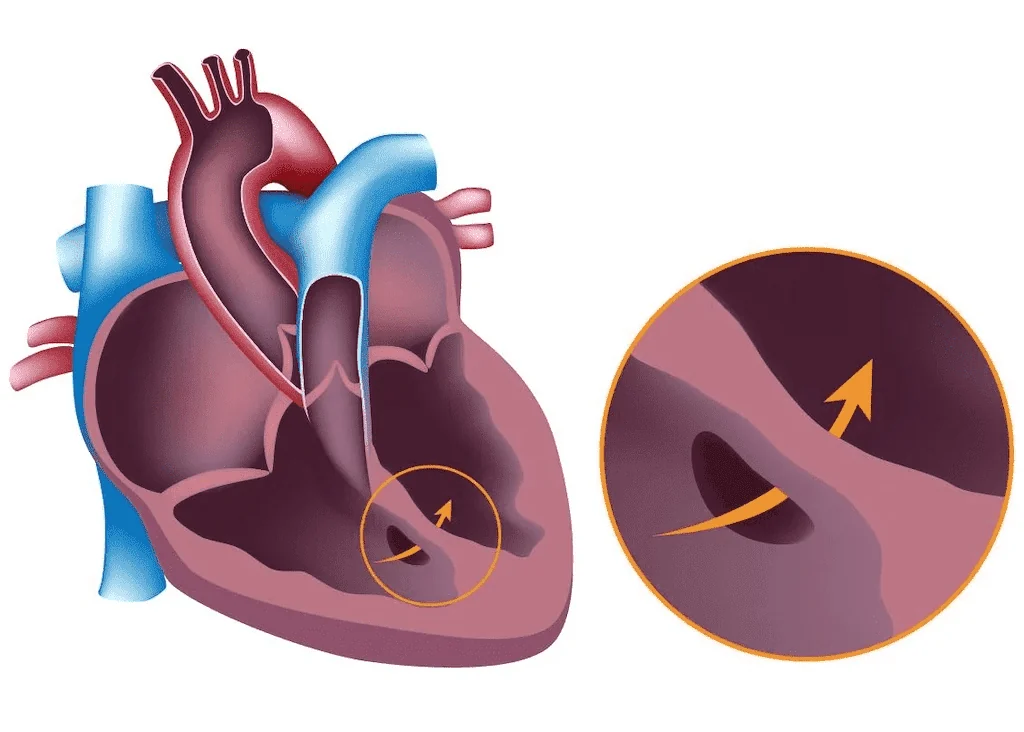 Malformations cardiaques