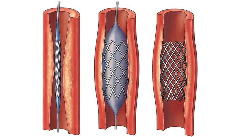 Angioplastie coronaire