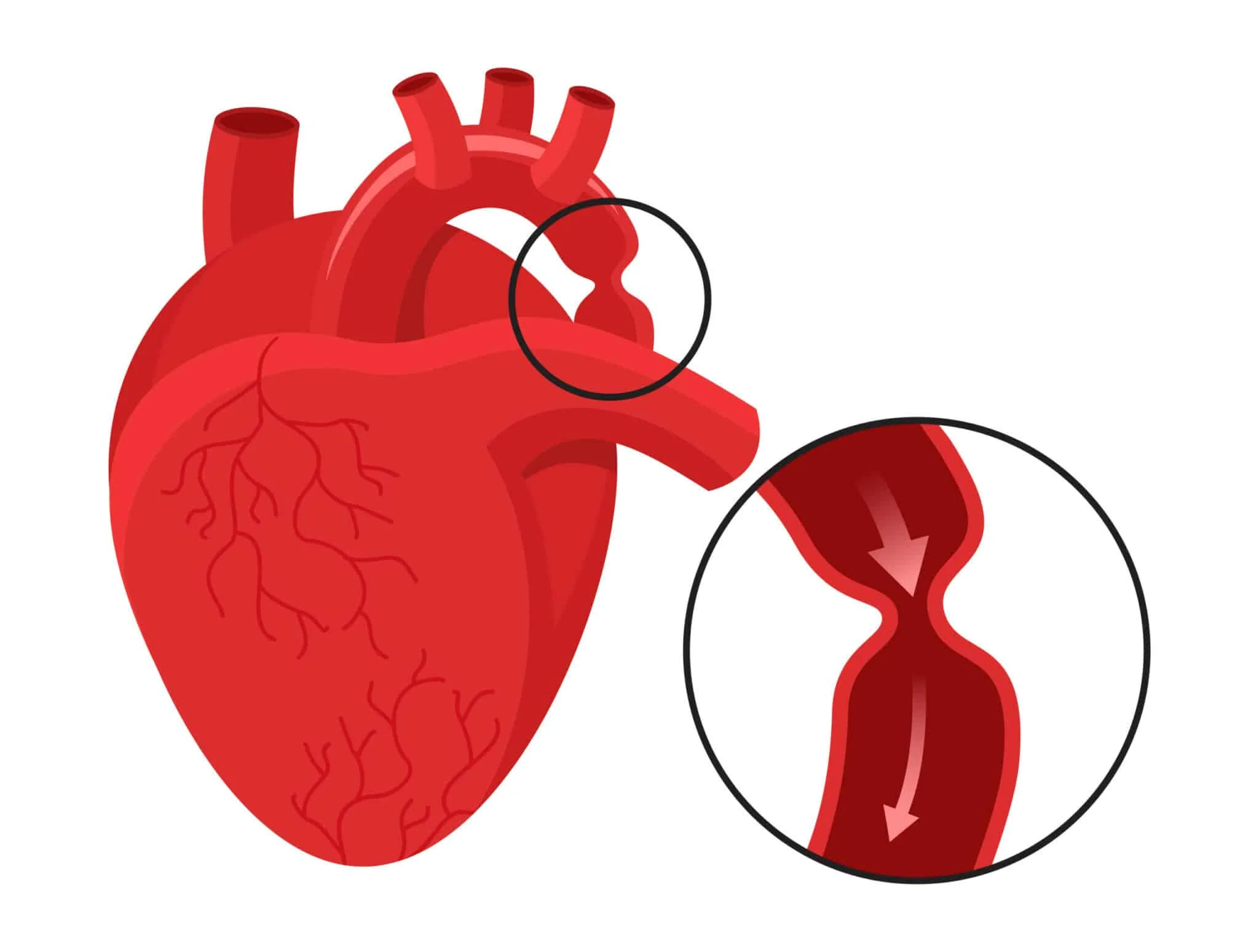 Coarctation de l'aorte