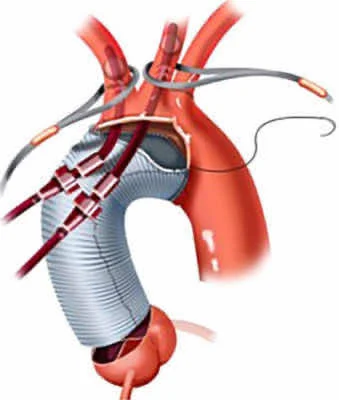 Dissection aortique