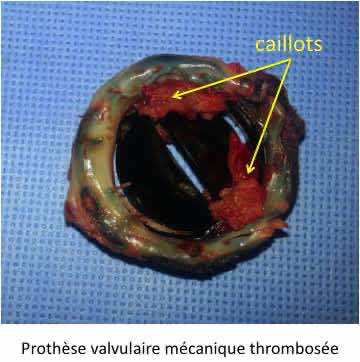 Prothèse valvulaire (thrombose / désinsertion)