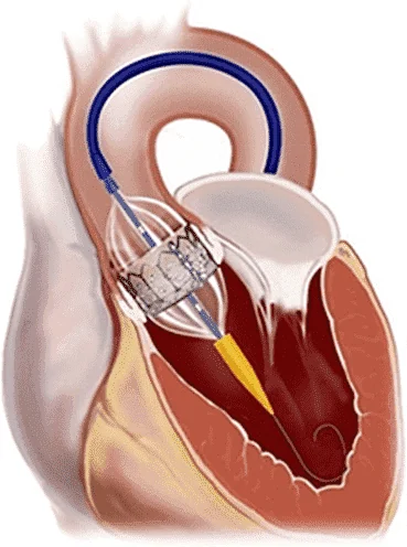 TAVI — valve aortique par cathéter