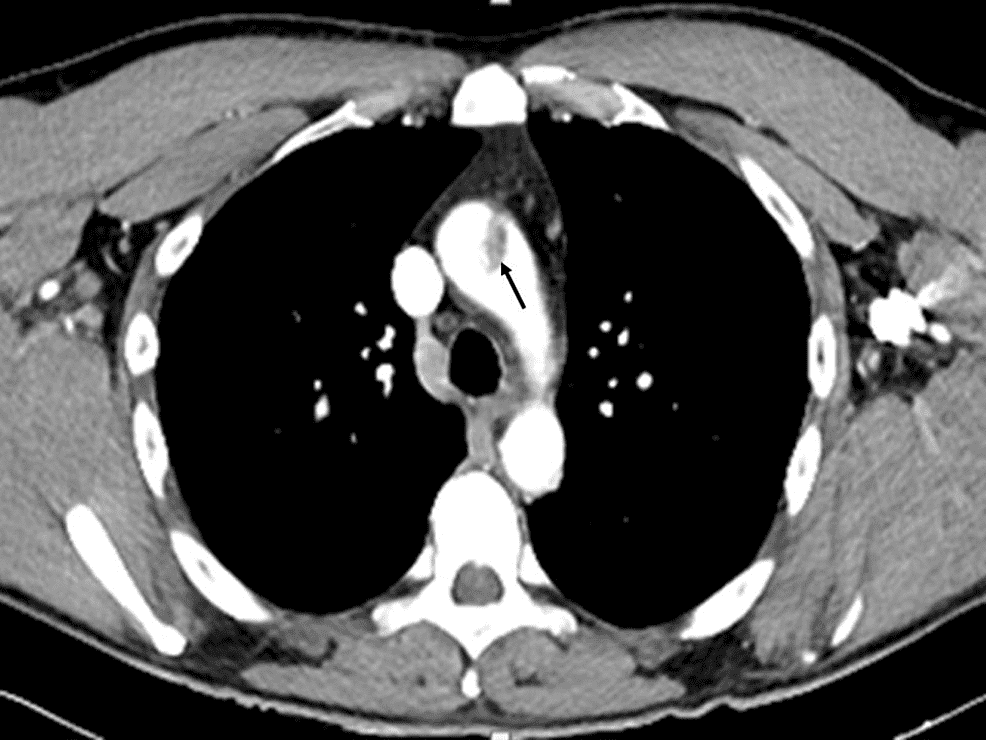 Thrombose de l'aorte