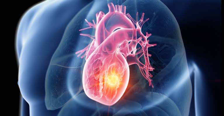 Tumeurs cardiaques