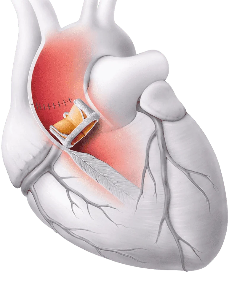 Chirurgie de la valve aortique