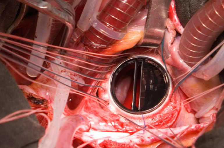 Chirurgie de la valve mitrale