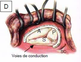 Chirurgie de la valve tricuspide